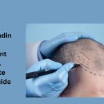 Understanding Hair Transplant Cost: A Complete Pricing Guide