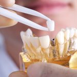 Dental Aligners Cost in Pune: Treatment Cost, Benefits & FAQs