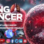 Top 10 Symptoms of Lung Cancer